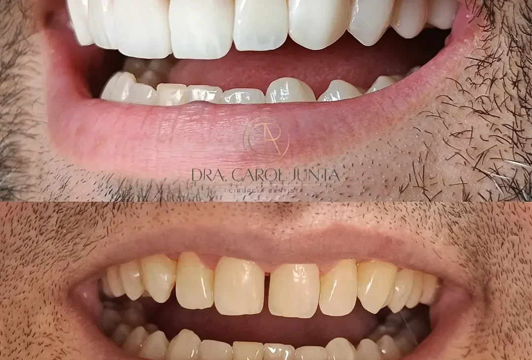 facetas de resina em rio preto