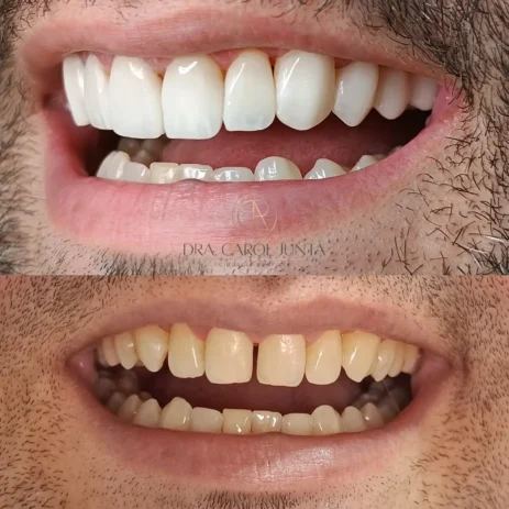 facetas de resina em rio preto